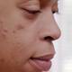 Image for article titled Dr. Pimple Popper and the Half-Head Removal